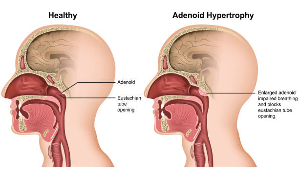 Adenoid Surgery