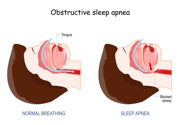 obstructive sleep apnoea